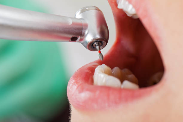Best Emergency Dentist for Knocked-Out Tooth in South San Jose Hills, CA